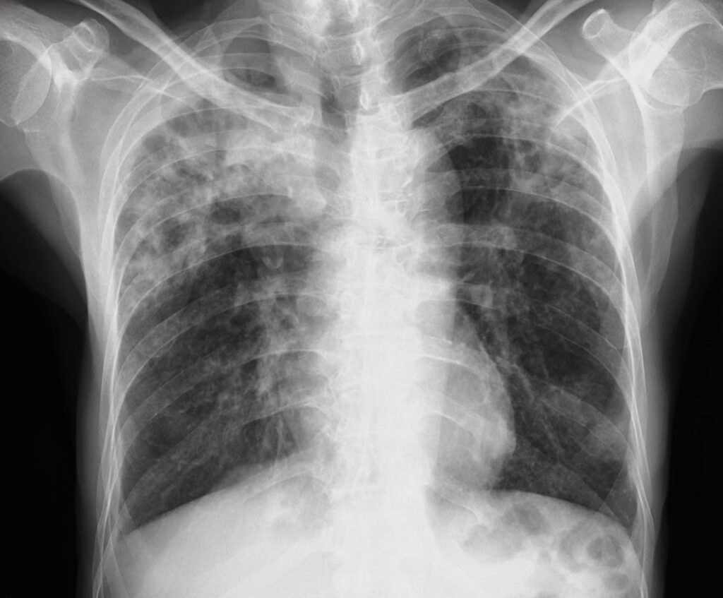 Global Health Cuts Threaten Fight Against Tuberculosis