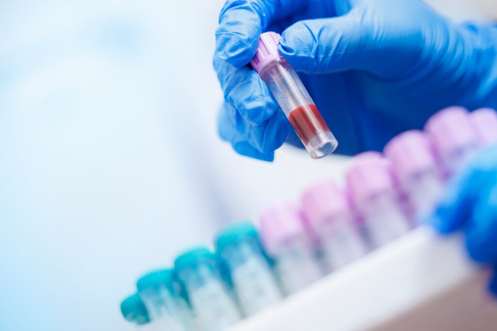 Scientists Create First Reliable Blood Test for Chronic Fatigue Syndrome